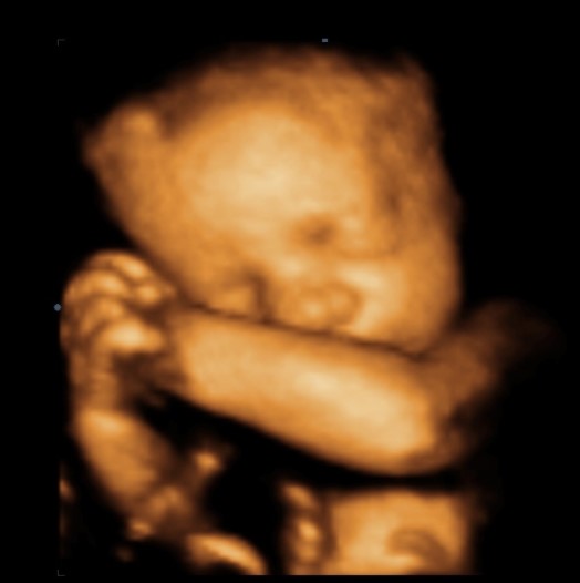 ¿Cuándo se considera retraso de crecimiento intrauterino?  ¿Qué pasa si un feto no crece?