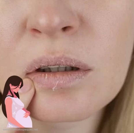 ¿Son comunes los labios agrietados durante el embarazo?