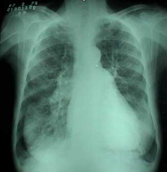 el tabaco genera bronquitis. Obstruye las vias respiratorias y la persona se cansa con facilidad