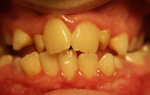 La maloclusión dental