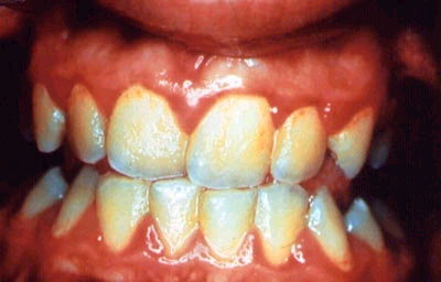 enfermedad periodontal