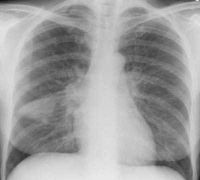 Cáncer de pulmón: El fumar es la primera causa del cáncer de pulmón. La brea va penetrando dentro de los pulmones, tornándolos negros. 31 de Mayo, día sin tabaco