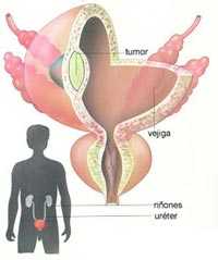 Cáncer de vejiga: Esté cáncer es mucho más común entre los fumadores