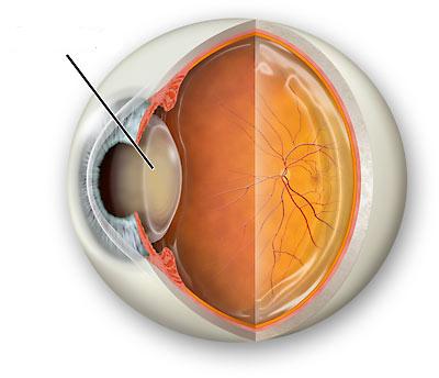 ojos con cataratas