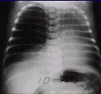 Enfisema: La brea del tabaco cubre las cavidades de aire los pulmones