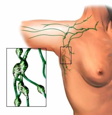 Linfedema