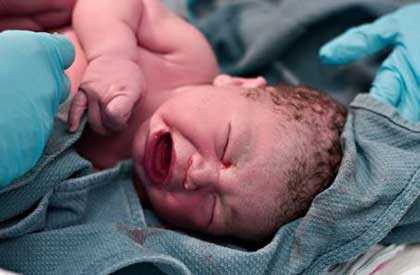 Hipoglucemia en los Recién Nacidos