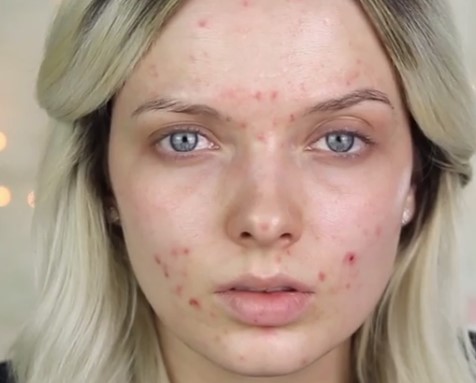 piel acne