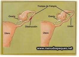 Obstrucción de las trompas de Falopio 