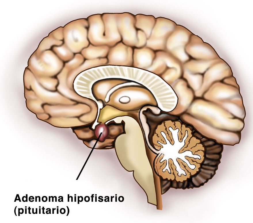 Adenoma hipofisario