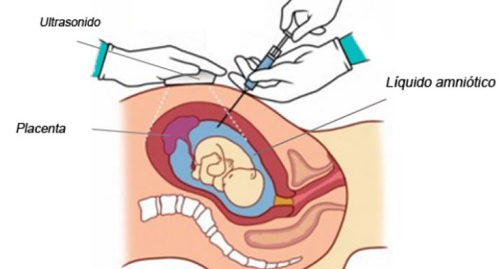 amniocentesis