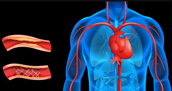 Angioplastia coronaria e inserción de stent