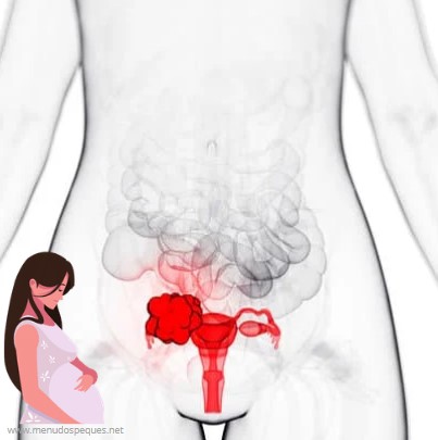 Cáncer de ovarios durante el embarazo ¿El cáncer de ovario afecta al bebé?