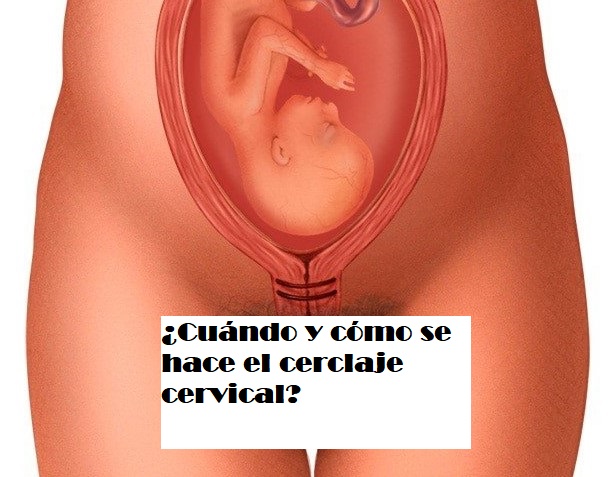 Cerclaje uterino cervical