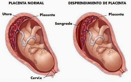 desprendimiento placenta manchado