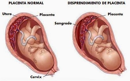 desprendimiento placenta manchado