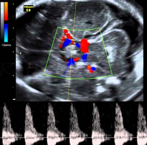 ¿Cuándo se hace la ecografía Doppler en el embarazo? ¿Qué se puede detectar en un Eco Doppler?