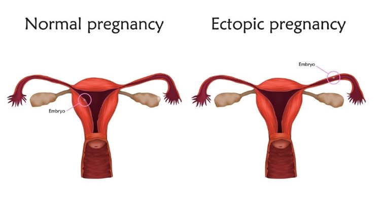 ¿Qué es el embarazo ectópico? - Tipos, síntomas, diagnóstico y tratamiento