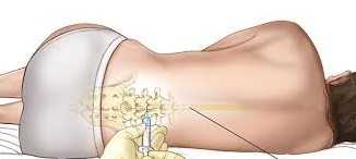 epidural ventajas