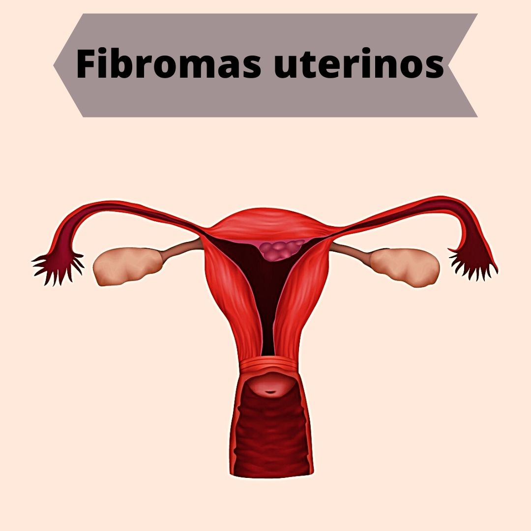 Fibromas uterinos en el embarazo, miomas, embarazada