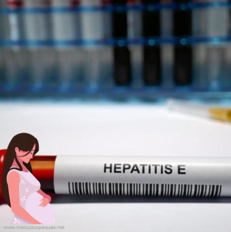¿Se puede tratar la hepatitis E durante el embarazo? ¿Puede la hepatitis E causar defectos de nacimiento?