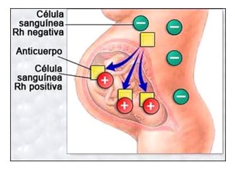 Factor RH y embarazo