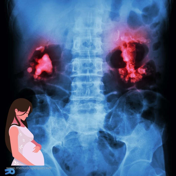 Insuficiencia renal durante el embarazo