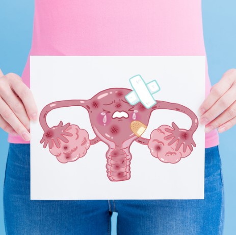 ¿Cuáles son las malformaciones uterinas?  ¿Cuáles son las malformaciones Mullerianas?