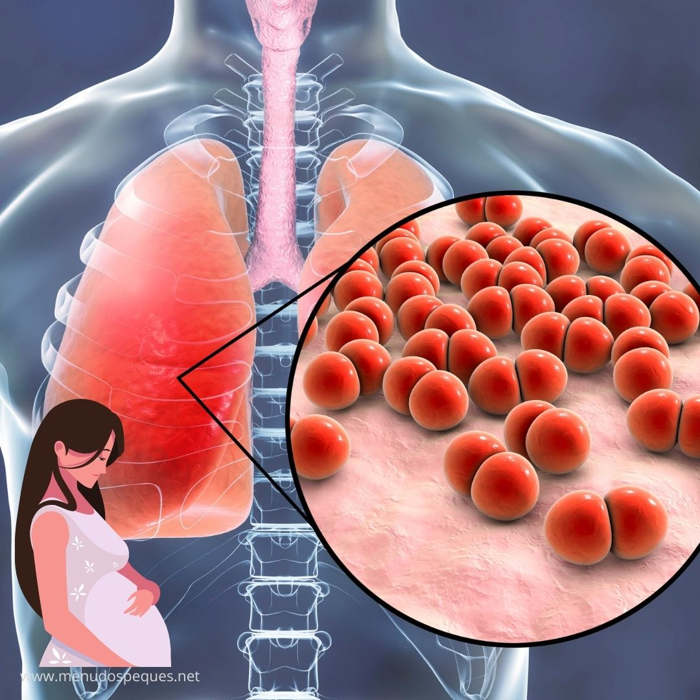 Neumonía durante el embarazo. Síntomas, causas, tratamiento