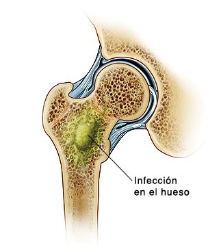 osteomielitis, huesos, infección 
