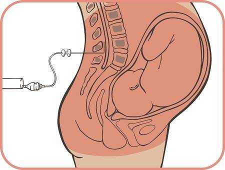 epidural