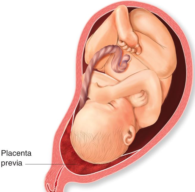 placenta previa síntomas