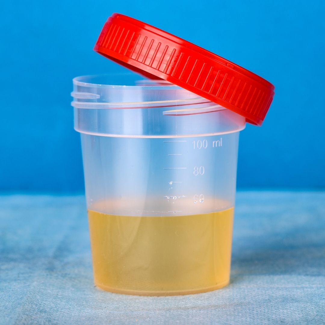 Proteinuria durante el embarazo