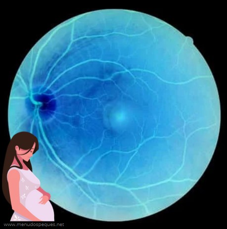 ¿Afecta el embarazo a la retina? ¿Puede el embarazo provocar un desprendimiento de retina?