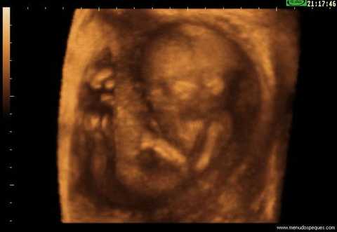 11 feto 17 semanas