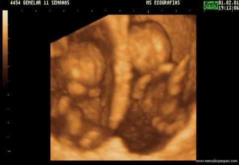 22 fetos gemelos 9 semanas