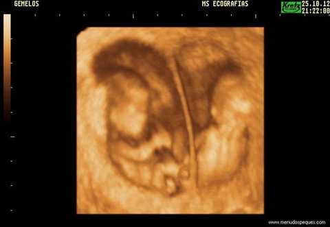 23 fetos gemelos 10 semanas
