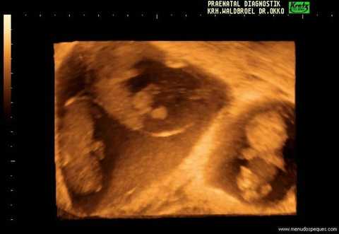 24 feto trillizos 8 semanas