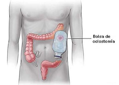 Colostomia