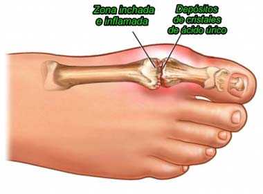 acido-urico-gota