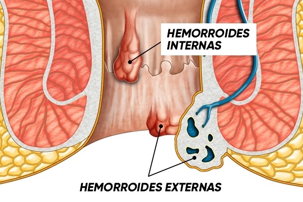 almorranas hemorroides