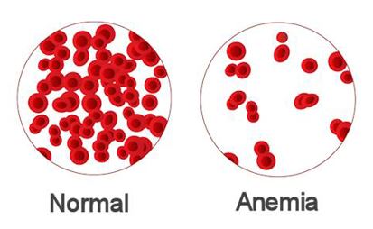 anemia