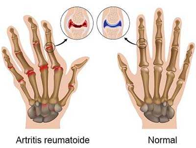 Articulaciones: Artritis Reumatoide e Inflamación