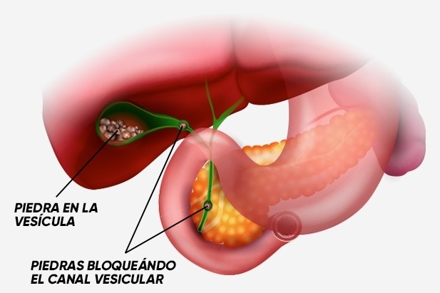 Cálculos biliares