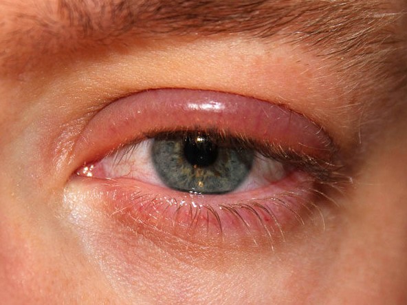 blefaritis ojos