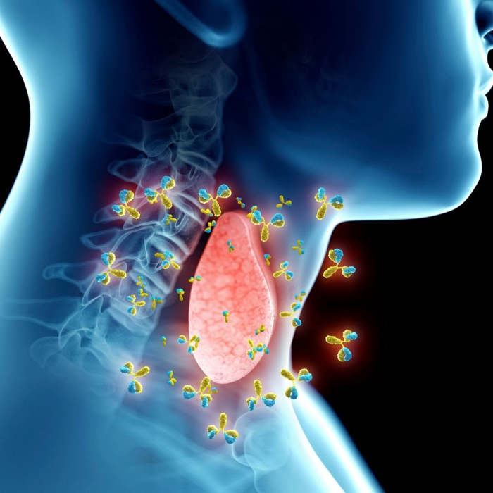bocio, tiroides, ¿Cuál es la causa del bocio?  ¿Cómo se sabe si se tiene bocio?