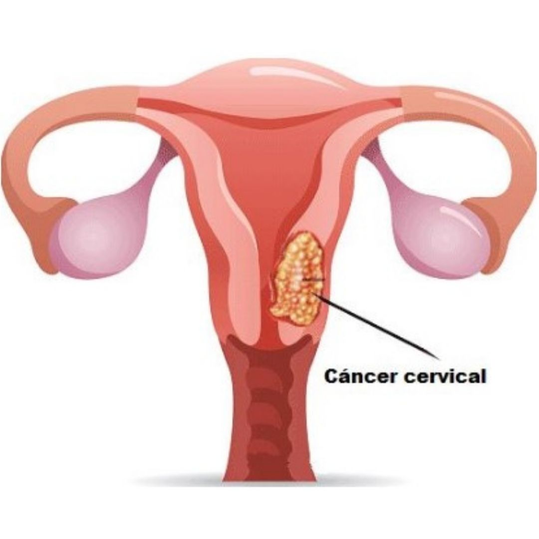 Cáncer del cuello del útero, cáncer cervical