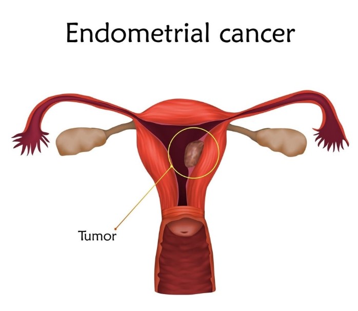 ¿Qué es el cáncer de endometrio? ¿Cuál es la causa del cáncer de endometrio?