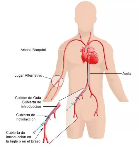 cateterismo cardiaco