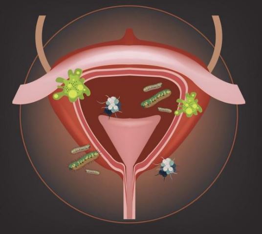 cistitis, infección urinaria